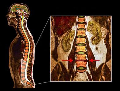 Degenerative disc