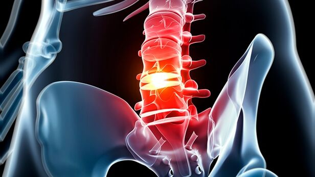 osteochondrosis of the spine