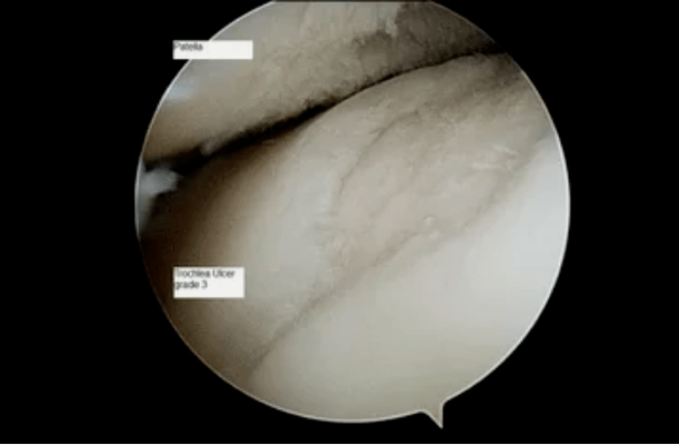 Astroscopic view of a knee joint with grade 3 osteoarthritis