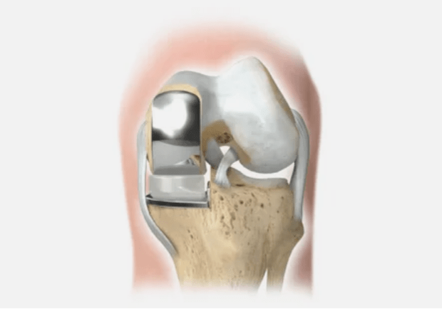 part of the joint is damaged